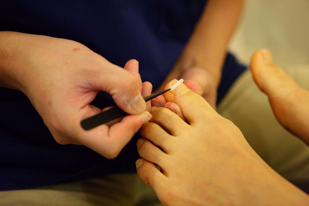 【東京巻き爪センター】足の爪が食い込んで痛かったのですが、矯正するにつれて痛みがなくなっていきました。